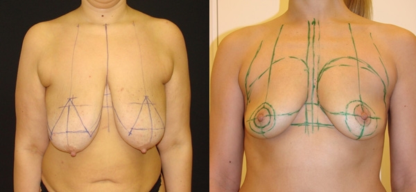 разметка груди