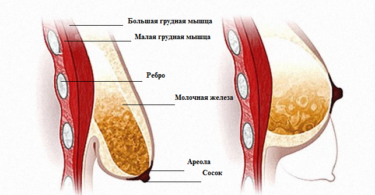 Мужчина пластика женская грудь