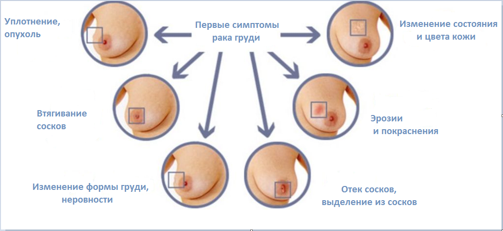 рак груди