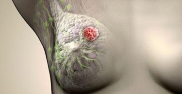 рак молочной железы 2 степени продолжительность жизни