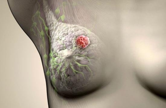 рак молочной железы 2 степени продолжительность жизни