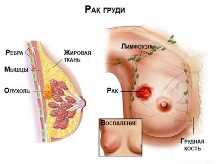 рак груди