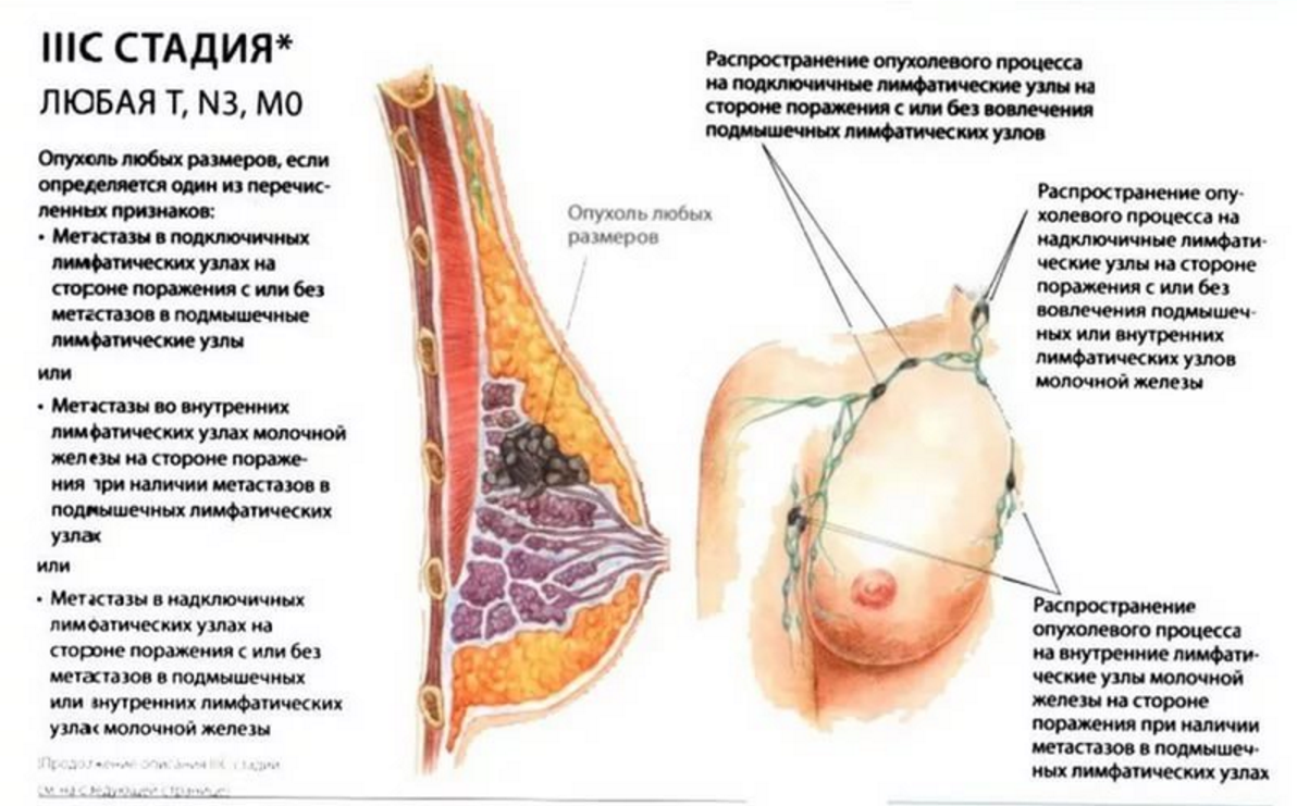 Лимфоузлы при рмж. Злокачественное новообразование молочной железы. Лимфоузлы млоочно йжелезхы. Внутренние лимфатические узлы молочной железы. Опухолевые процессы в груди.