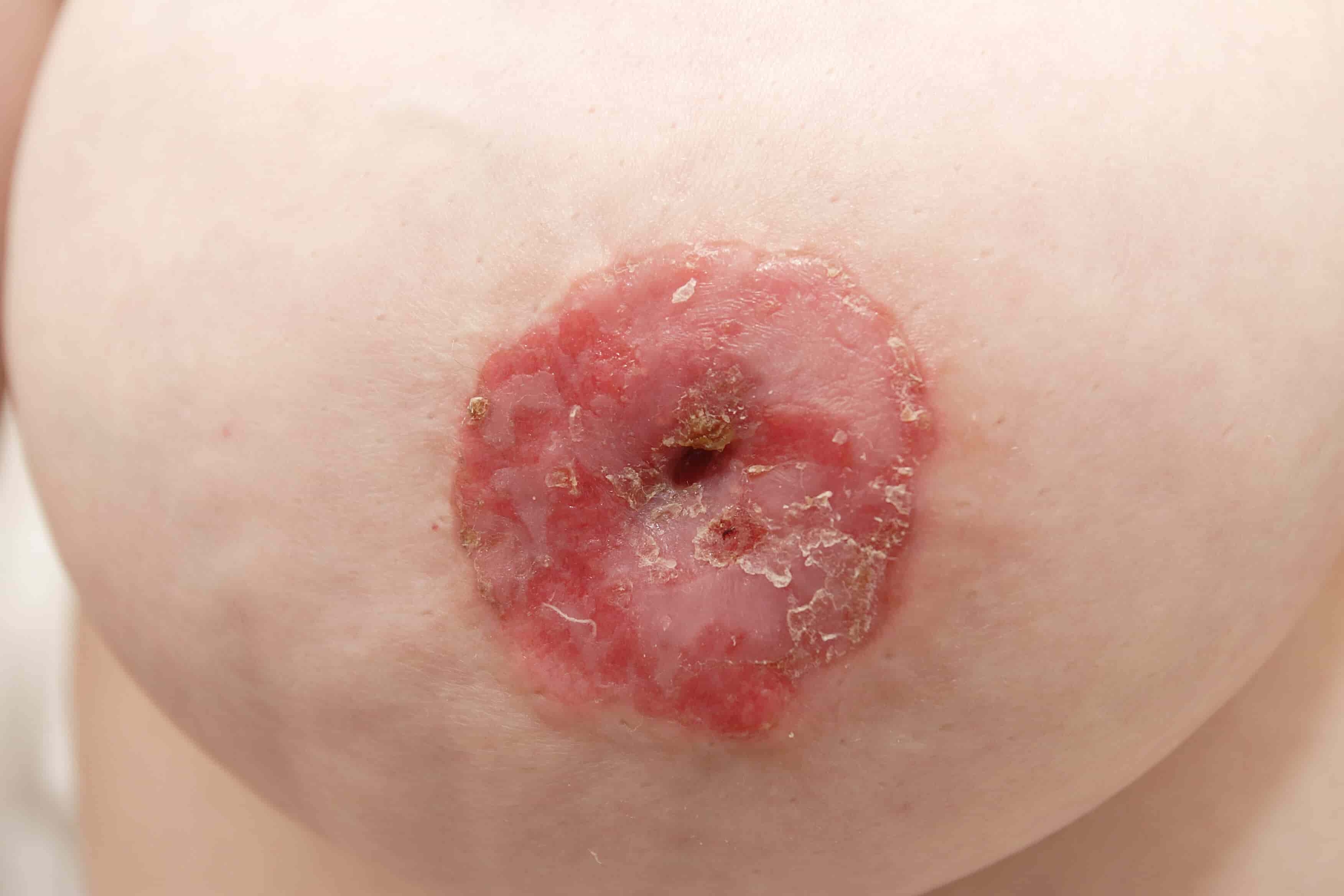 Paget carcinoma