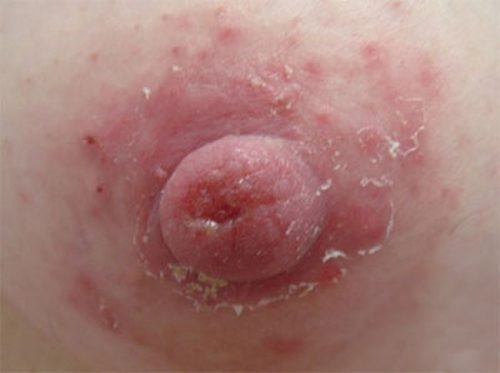 болезнь педжета