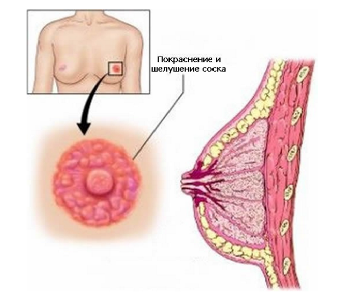 болезнь педжета