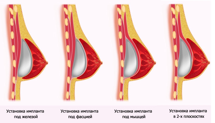 реабилитация после пластики груди