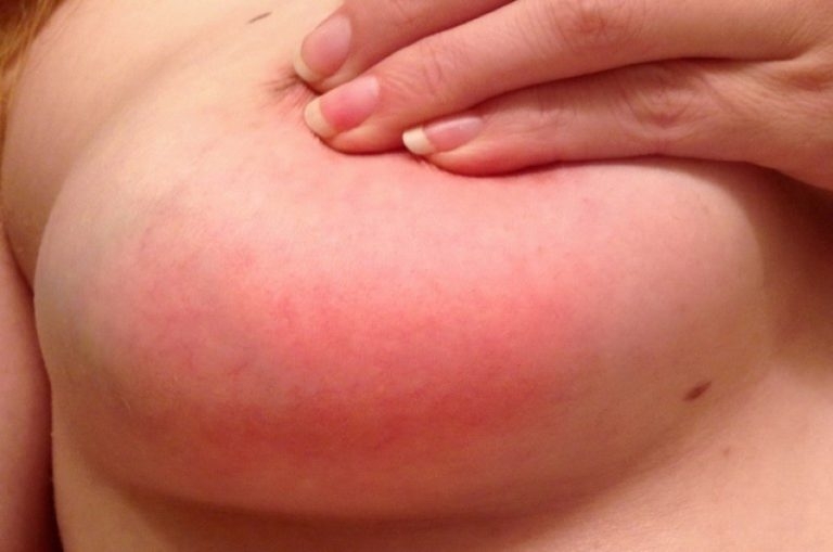 траумель при лактостазе