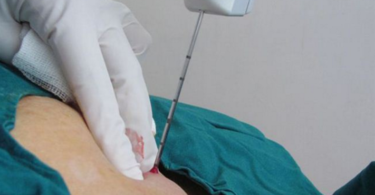 трепанобиопсия молочной железы