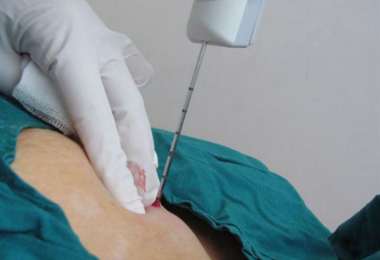 трепанобиопсия молочной железы