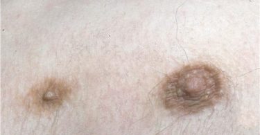 удаление третьего соска