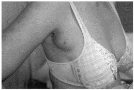 полимастия