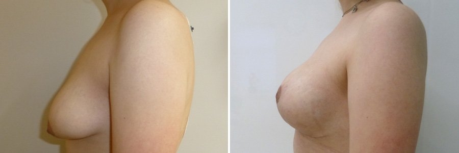 маммопластика