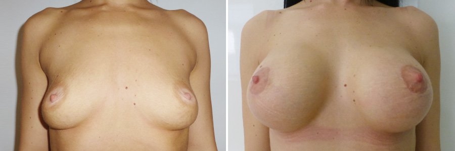 маммопластика