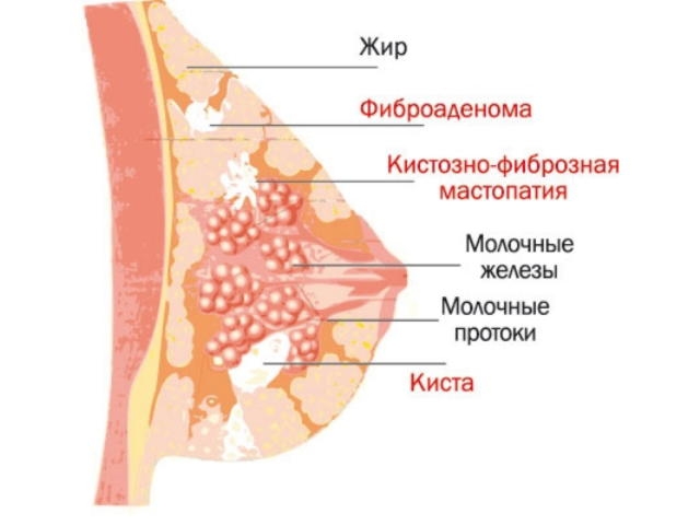 узловая мастопатия