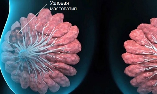 узловая мастопатия