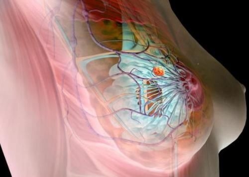 узловая мастопатия