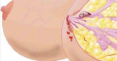 внутрипротоковая папиллома молочной железы