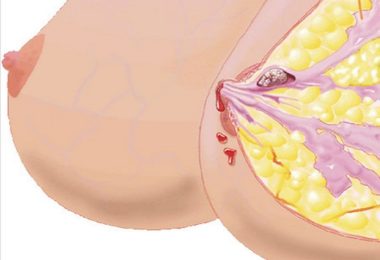 внутрипротоковая папиллома молочной железы