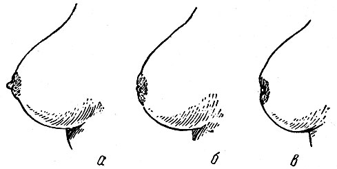 втянутые соски