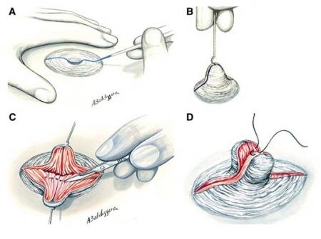 втянутые соски