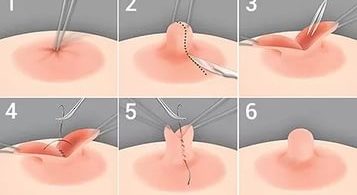 втянутые соски