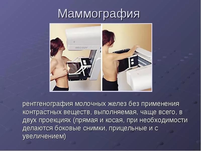рентгенография молочных желез