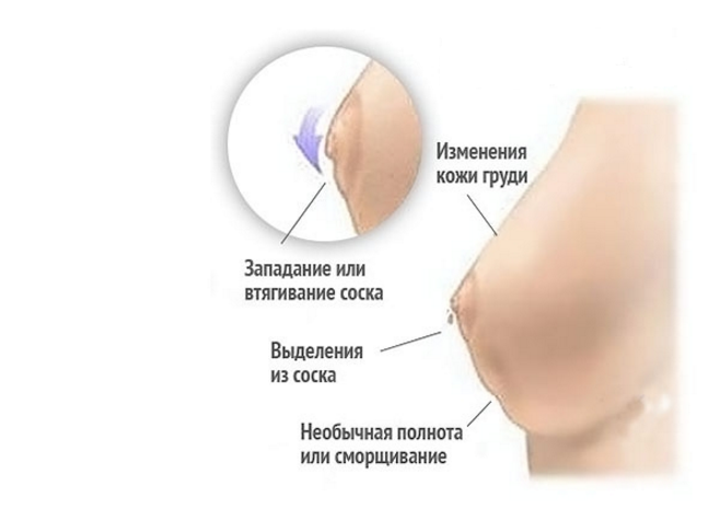 выделения из груди