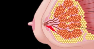 закупорка молочного протока белая точка